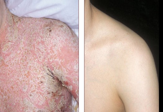 psoriasis patient before and after treatment